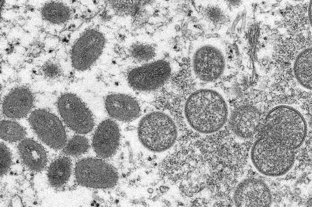 中國疾控中心：重慶猴痘病例病毒與德國病毒高度同源