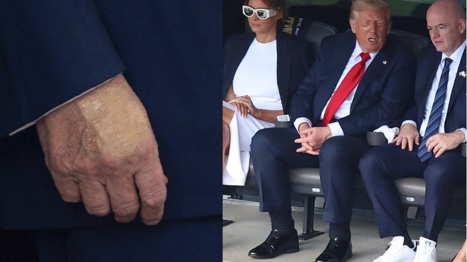 美國總統特朗普被確診患靜脈疾病