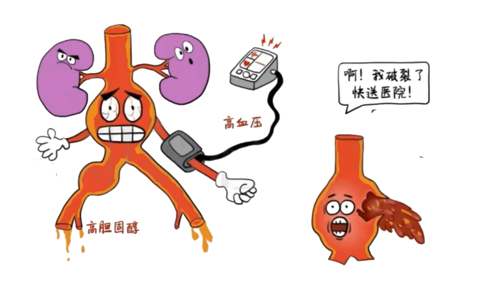 雜交手術室里的「拆彈戰」！     深圳二院血管外科搶救腹主動脈瘤破裂患者