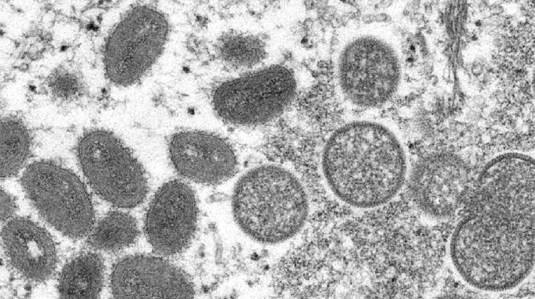 世衛組織：歐洲仍舊是近期猴痘發病中心